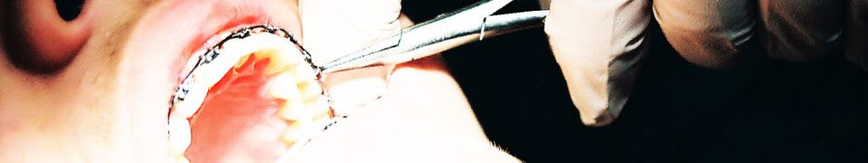 Rubber gloves holding dental tools working on a patients orthodontic equipment