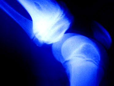 X-Ray image of a knee joint
