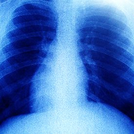X-ray of a chest cavity